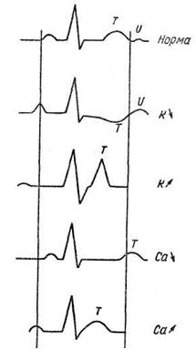 Myocardiodystrophy - o electrocardiogramă pentru anumite boli și sindroame - practice