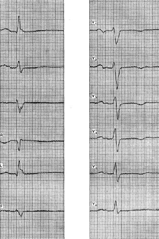 Myocardiodystrophy - o electrocardiogramă pentru anumite boli și sindroame - practice