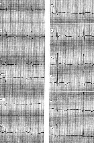 Myocardiodystrophy - o electrocardiogramă pentru anumite boli și sindroame - practice