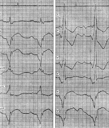 Myocardiodystrophy - o electrocardiogramă pentru anumite boli și sindroame - practice