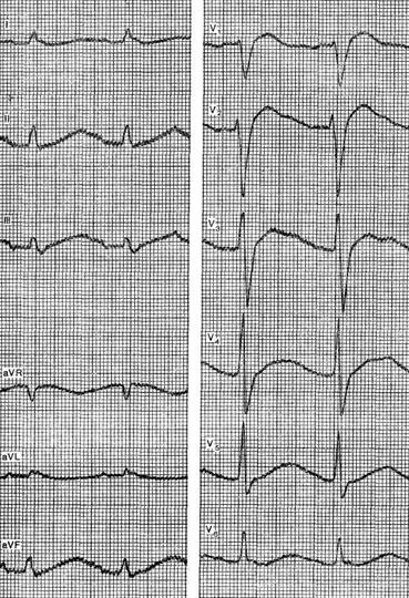 Myocardiodystrophy - o electrocardiogramă pentru anumite boli și sindroame - practice