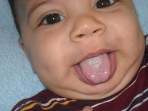 Úszás az újszülötteknél a szájban, a nyelvben - okok, tünetek, kezelés (fotó, vélemények)