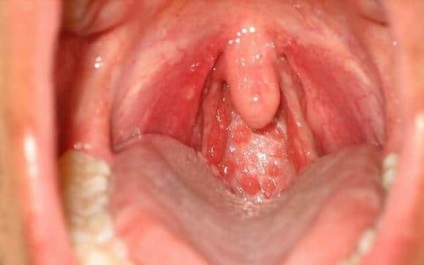 Rasește nasul în gât, de unde vine mucusul și cum îl eliminăm
