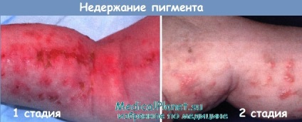 Incontinența pigmentului (np) - diagnostic, tratament