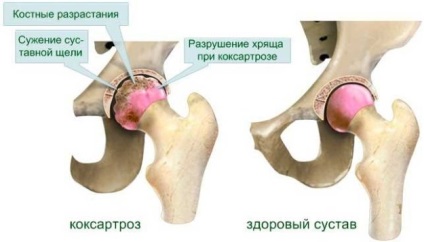 Umflarea coapsei - cauze și tratament, video de umflături dentare