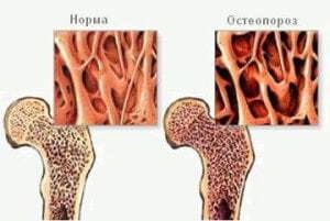 Umflarea coapsei - cauze și tratament, video de umflături dentare