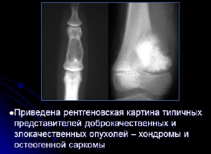 Tumori ale oaselor și articulațiilor, eurolab, traumatologie