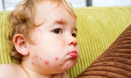 Caracteristicile varicelei la copii, tratamentul adecvat al bolii