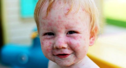 Caracteristicile varicelei la copii, tratamentul adecvat al bolii