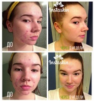 Comentarii despre - instaskin - acne cream