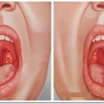 Parodontoza cauzează, simptome și tratament la domiciliu