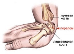 Fractura de tratament și simptomele mâinii