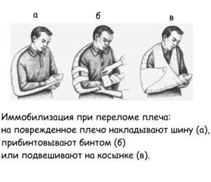 Перша допомога при травмах суглобів, переломах