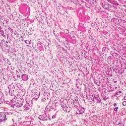 Carcinom cu celule scuamoase sau tumori maligne operabile - bisturiu - medical