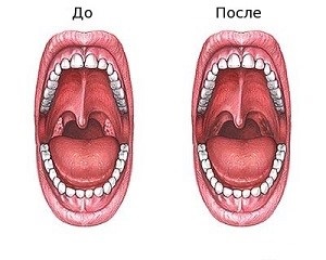 Consecințele după îndepărtarea amigdalelor (amigdale) la femeile și copiii adulți - informații despre sănătate