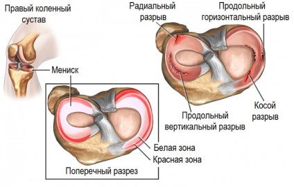Deteriorarea diagnosticului, tratamentului meniscului la nivelul genunchiului medial