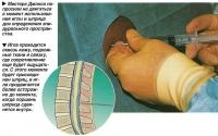 Exemplu de anestezie epidurală (tratament - chirurgie)