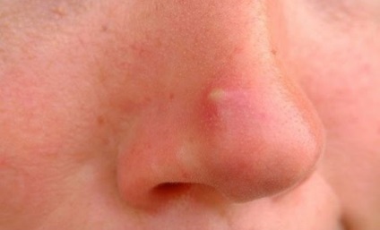 Pimple nu durează mult - pe nas, de la varicela, pete, la copil, urme, pe față