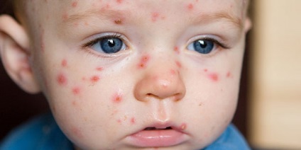 Pimple nu durează mult - pe nas, de la varicela, pete, la copil, urme, pe față