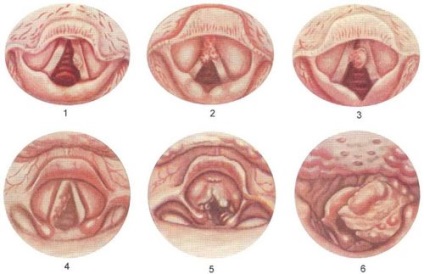 Cancerul simptomelor laringelui, manifestarea, semnele, diagnosticul și tratamentul