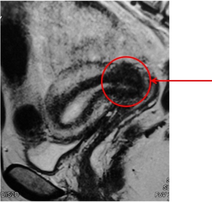 Cancerul de col uterin