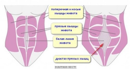 Diferența dintre linia albă a abdomenului după naștere