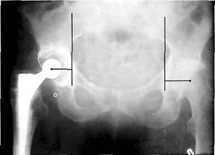 Evaluarea razei X a artroplastiei primare a articulației șoldului - endoprotetice,