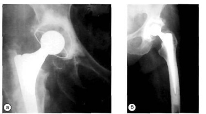 Evaluarea razei X a artroplastiei primare a articulației șoldului - endoprotetice,