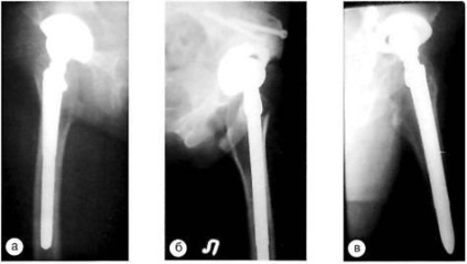 Evaluarea razei X a artroplastiei primare a articulației șoldului - endoprotetice,