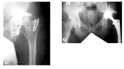 Evaluarea razei X a artroplastiei primare a articulației șoldului - endoprotetice,
