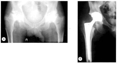 Радиологична оценка на първична хип артропластика - смяна на тазобедрената става,