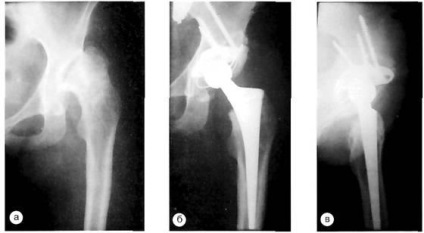 A csípőízület elsődleges artroplasztikájának röntgenvizsgálata - endoprotetikumok,