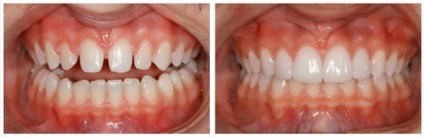 Restaurarea vârfurilor dinților dentiștilor