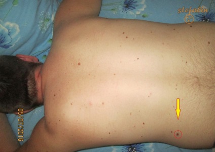 Mole a hátán aggódik, és miután a sérülés meg kell találni a módját, hogy távolítsa el a birthmark