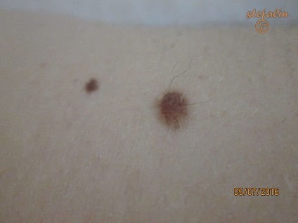 Mole a hátán aggódik, és miután a sérülés meg kell találni a módját, hogy távolítsa el a birthmark