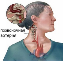 A Cheyno mellkasi osteochondrosis a tüneteket és a kezelést jelzi