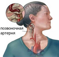 Шийно грудної остеохондроз ознаки симптоми і лікування