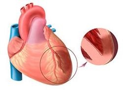 Simptomele și tratamentul insuficienței cardiace cronice