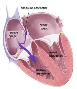 Simptomele și tratamentul insuficienței cardiace cronice