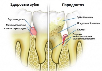 Simptomele bolii parodontale și baza pentru prevenirea bolilor