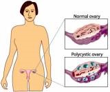 Sindromul ovarului polichistic - tulburare de ciclu - diagnosticul consultației ginecologice de obstetrică