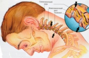 Sindromul simptomelor și tratamentului arterei vertebrale