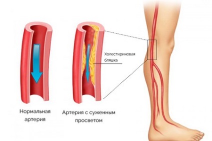 Scleroza vasculară a simptomelor și tratamentului extremităților inferioare