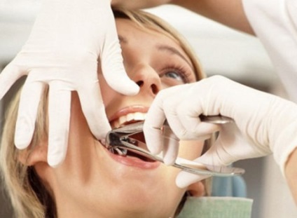 Câte gume vindecă după extracția dinților - etapele vindecării țesuturilor moi și osoase