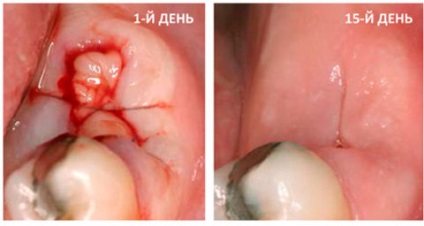 Câte gume vindecă după extracția dinților - etapele vindecării țesuturilor moi și osoase