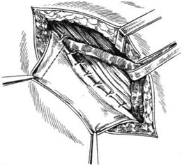 Metode de întărire a peretelui posterior al canalului inghinal