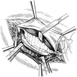 Metode de întărire a peretelui posterior al canalului inghinal