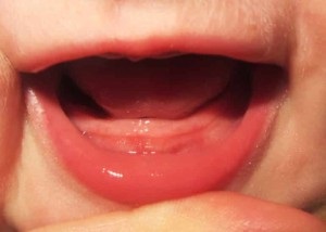 Lumânări cu dentiție la copii - cele mai bune analgezice