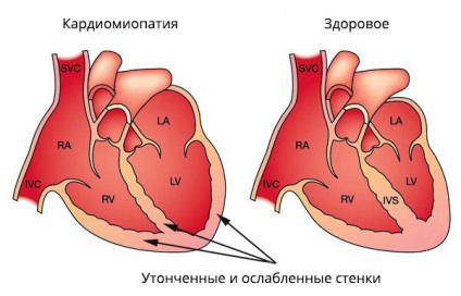 Cardiomiopatia cardiacă - ce este, simptomele și tratamentul