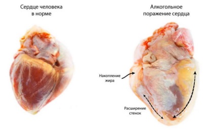 Toxic cardiomiopatia cauzează dezvoltarea, tratamentul și prevenirea